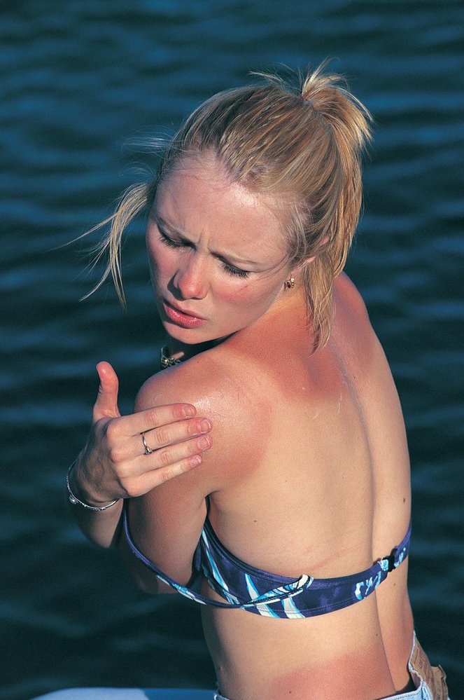Женщина с солнечным ожогом на плечах на фоне моря